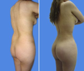 lipoplastia