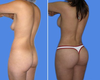lipoplastia