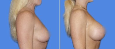 mamoplastia 
