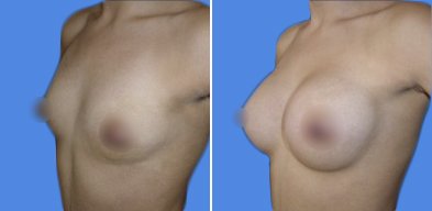 mamoplastia de aumento