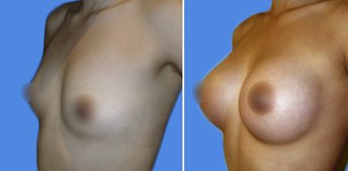 mamoplastia de aumento