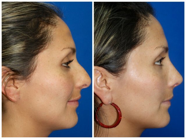 RINOPLASTIA1