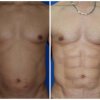 marcacion de abdomen3