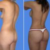 lipoplastia lipoinjerto