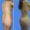 lipoplastia-lipoinjerto