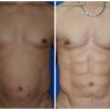 marcacion de abdomen3