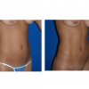 marcacion de abdomen2